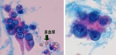 尿検査で膀胱ガン細胞を検出 独立行政法人国立病院機構 東名古屋病院